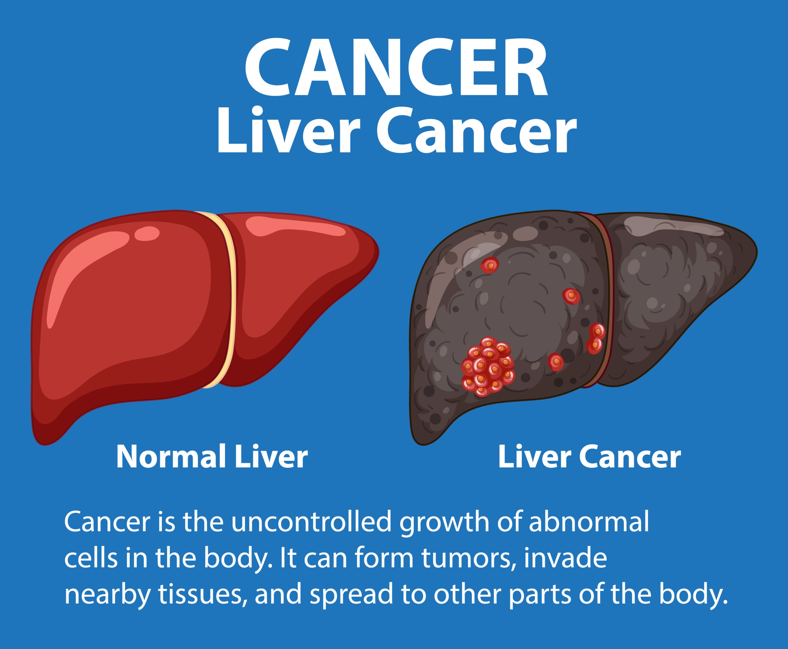 Cancer Treatment for Liver - liver cancer 4 stage - baja cell therapy - stem cell Therapy