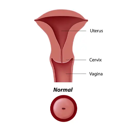 Stem Cells Cervical Cancer