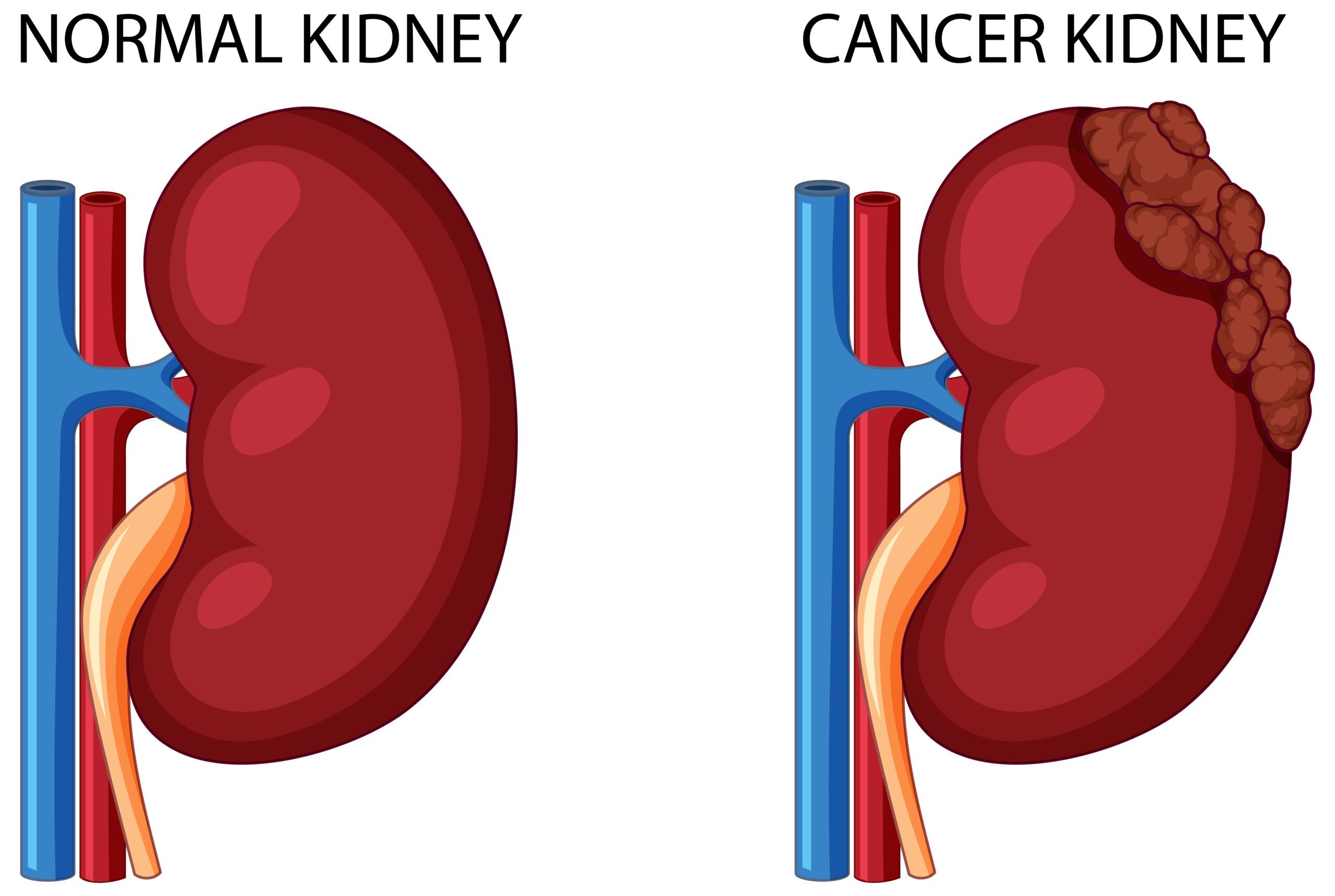 stem cells kidney cancer stem cell tijuana mexico