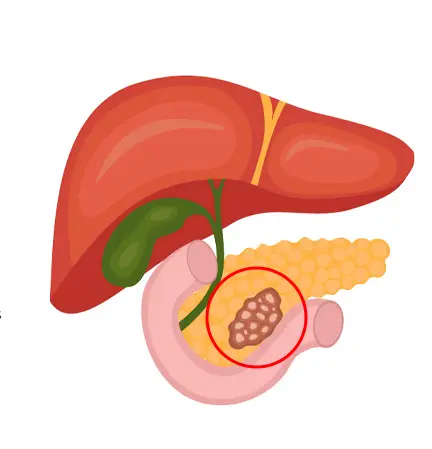 Stem Cell Therapy Pancreatic Cancer